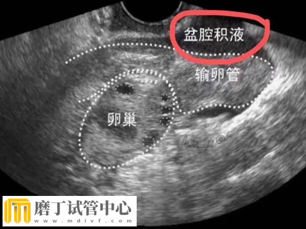 输卵管积液会不会影响试管移植(图2)