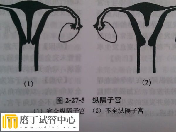 0.5厘米子宫纵隔怀试管双胎有没有成功的(图1)