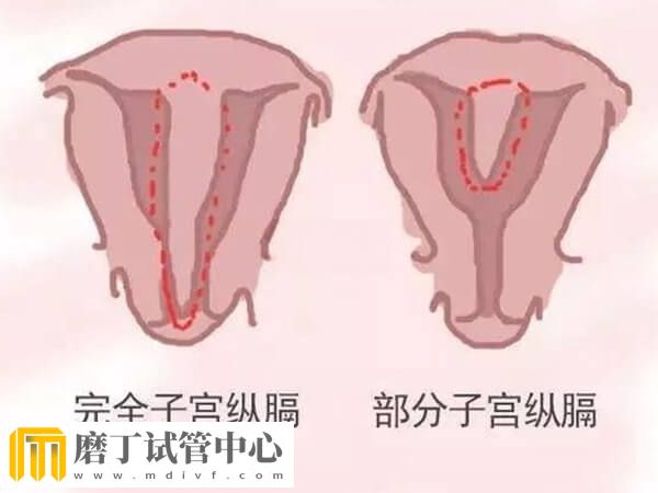 0.5厘米子宫纵隔怀试管双胎有没有成功的(图2)