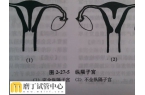 0.5厘米子宫纵隔怀试管双胎有没有成功的
